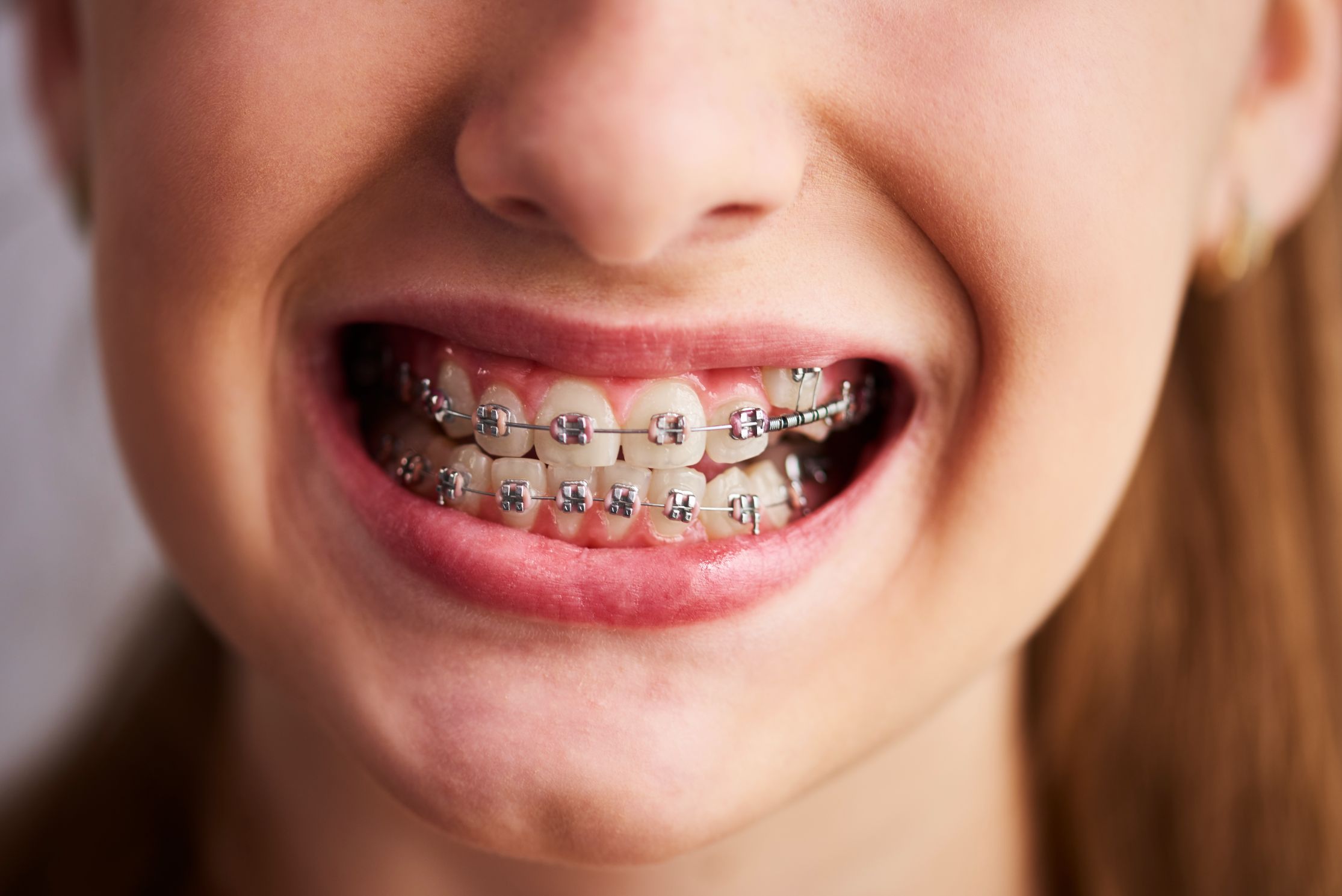 Braces In North Haven